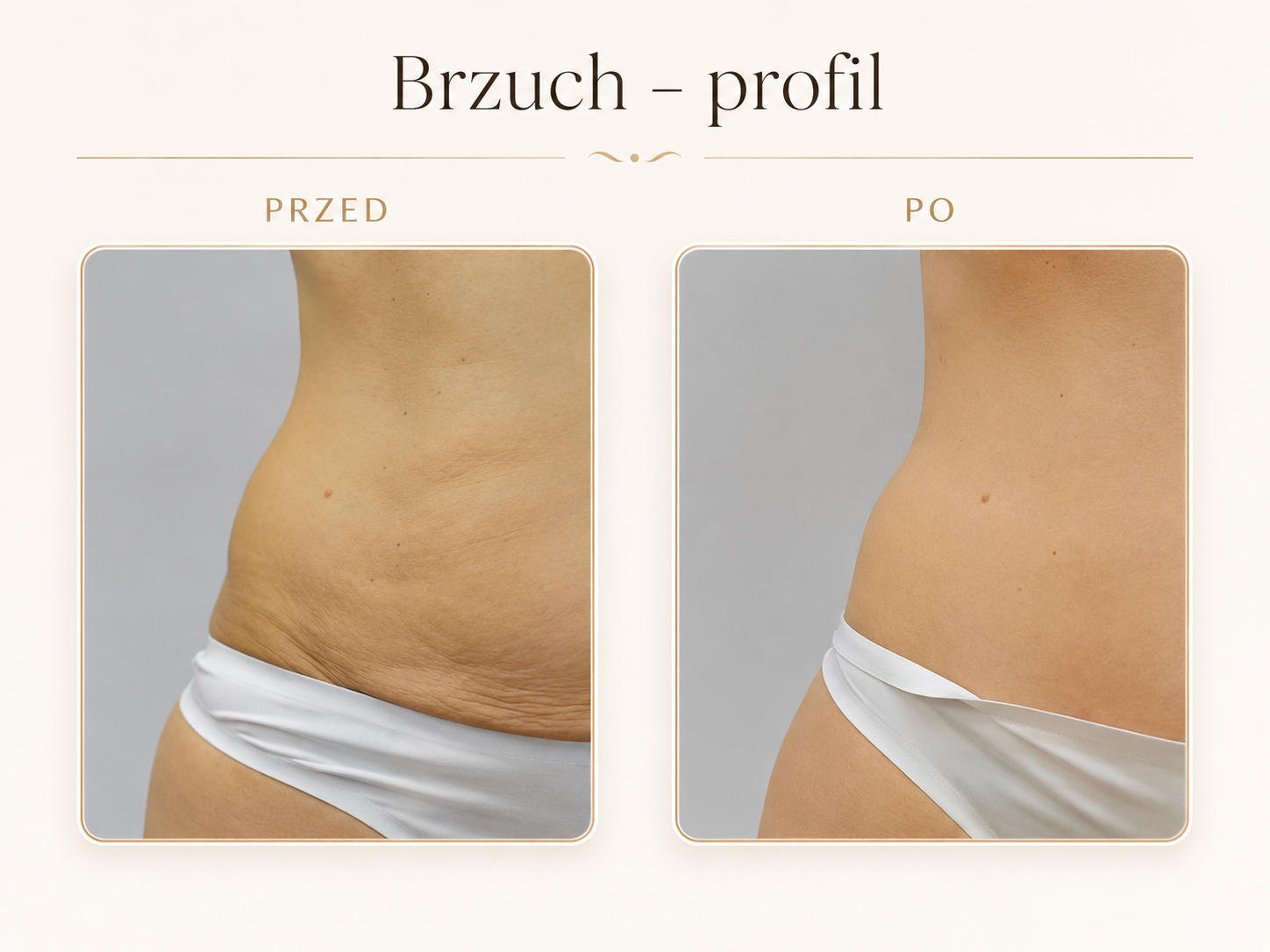 Endermologia LPG Krosno — efekt przed i po: Brzuch — profil