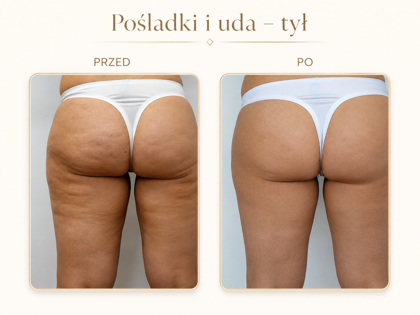 Endermologia LPG Krosno — efekt przed i po: Pośladki i uda — tył