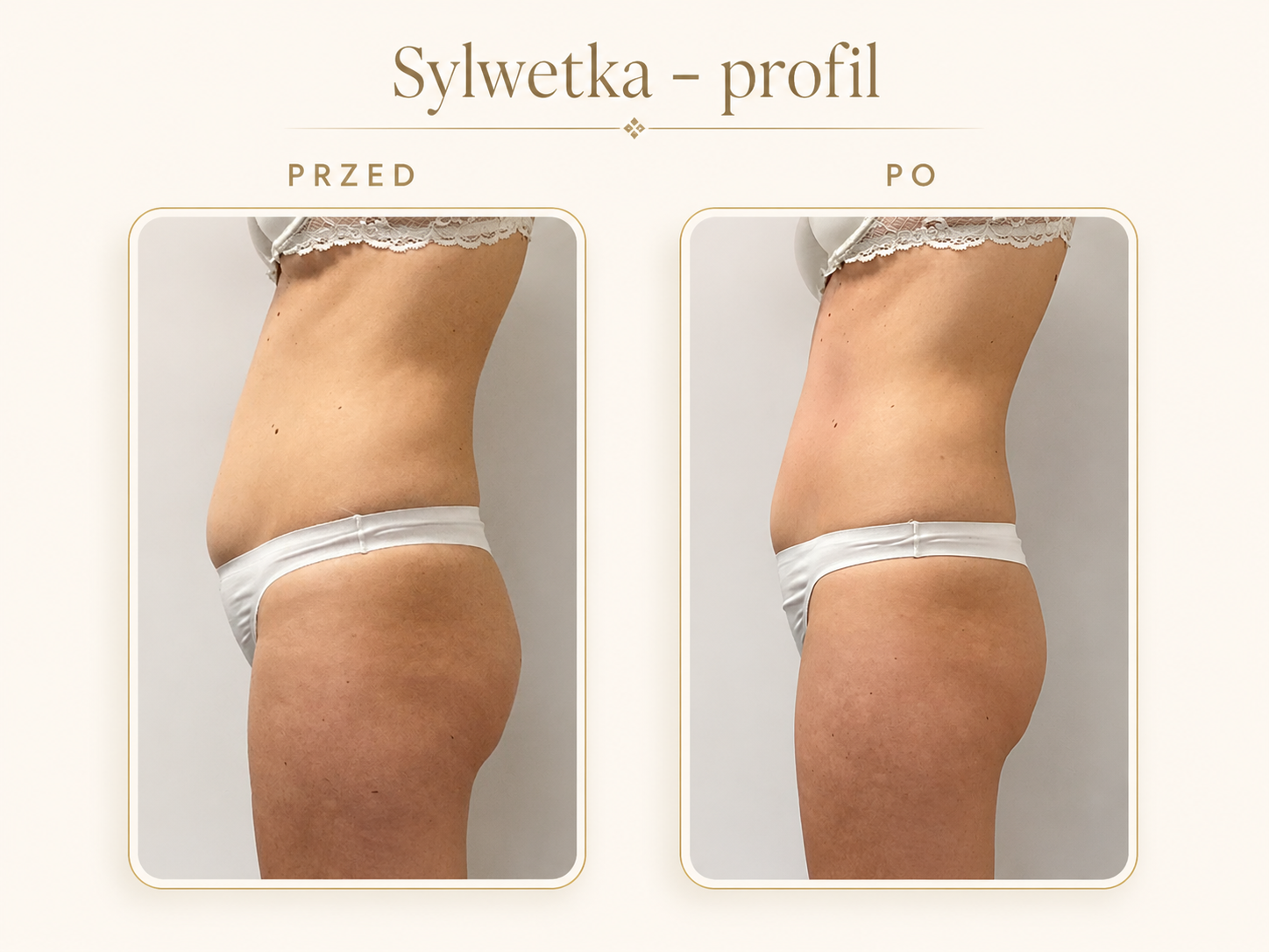 Endermologia LPG Krosno — efekt przed i po: Sylwetka — profil