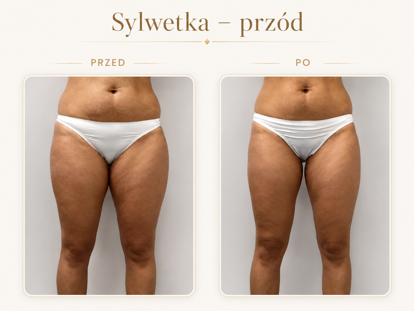 Endermologia LPG Krosno — efekt przed i po: Sylwetka — przód