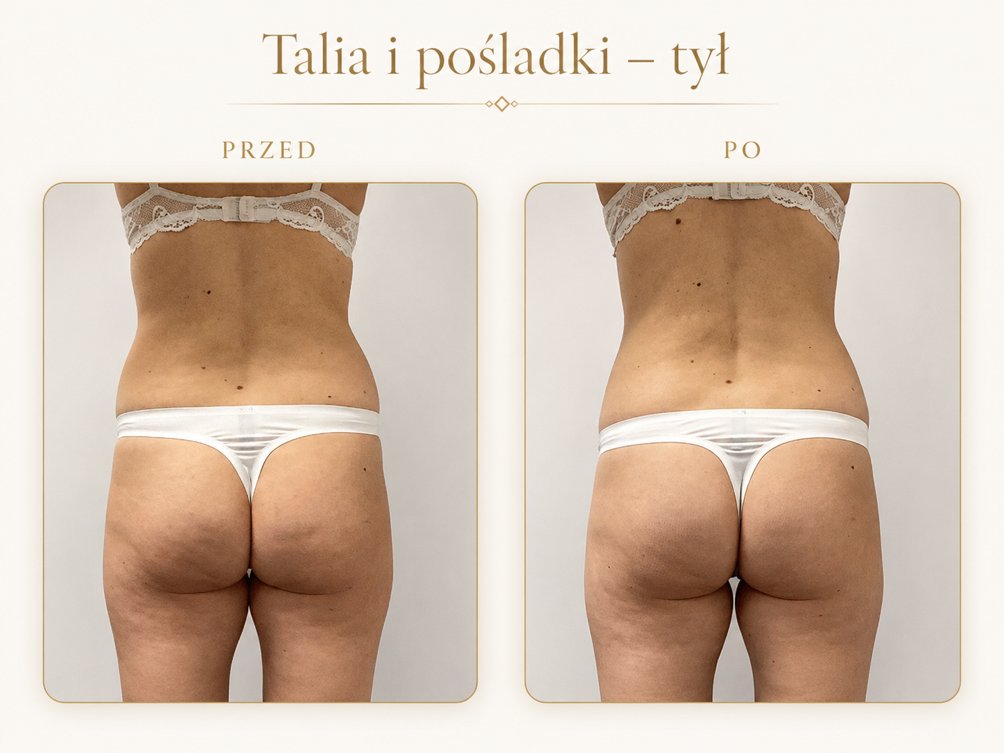 Endermologia LPG Krosno — efekt przed i po: Talia i pośladki — tył