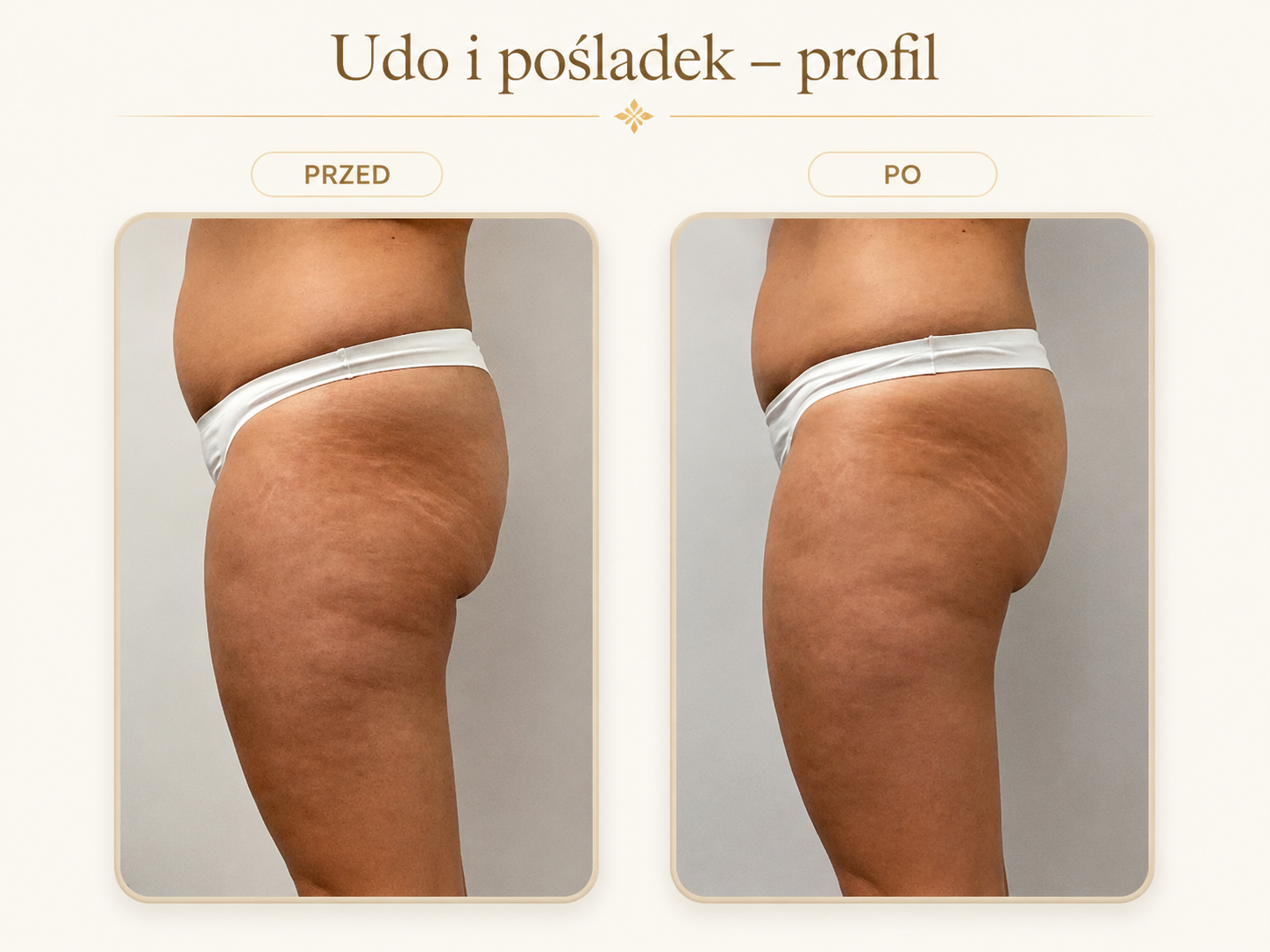 Endermologia LPG Krosno — efekt przed i po: Udo i pośladek — profil