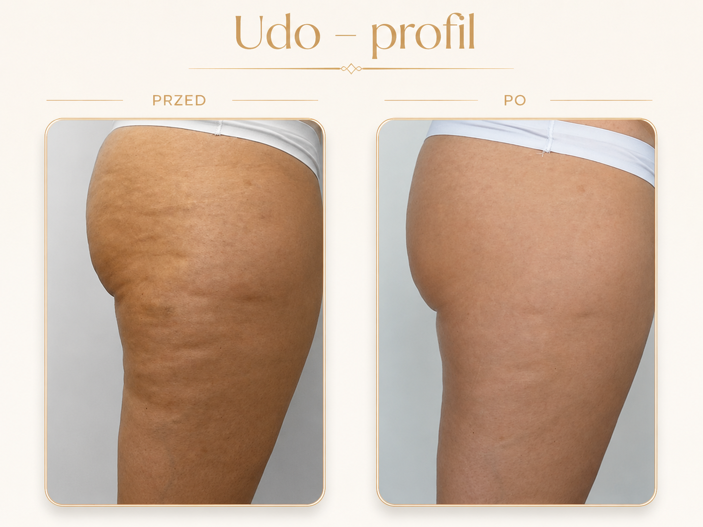 Endermologia LPG Krosno — efekt przed i po: Udo — profil