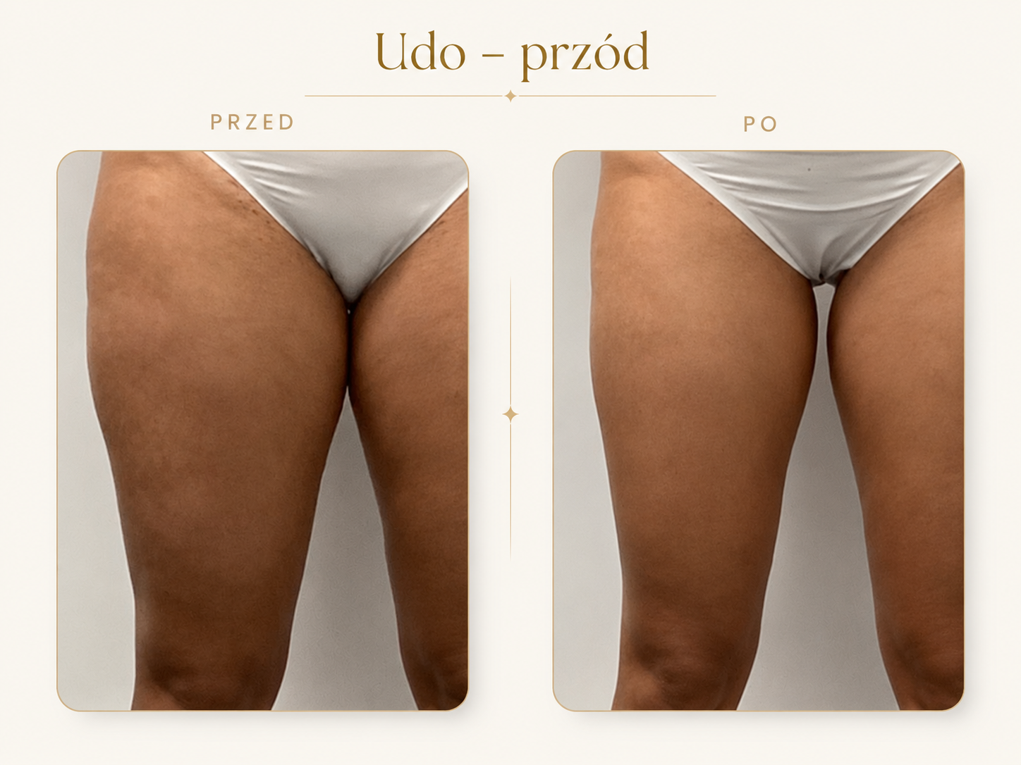 Endermologia LPG Krosno — efekt przed i po: Udo — przód